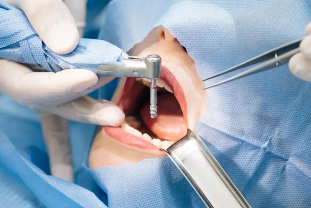 Dental Implants Adelaide